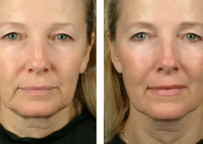 Therma-Lift-Patient-Before-and-after-Results-of-woman