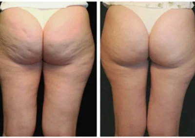 Therma-Lift-female-butt-lift-nonsurgical-before-and-after-results