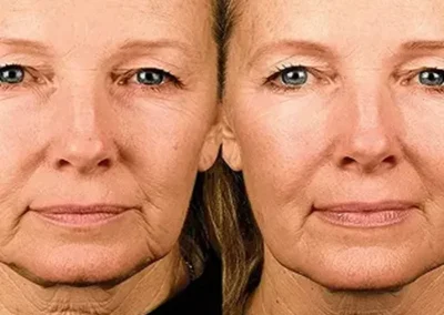 Facial Services San Diego