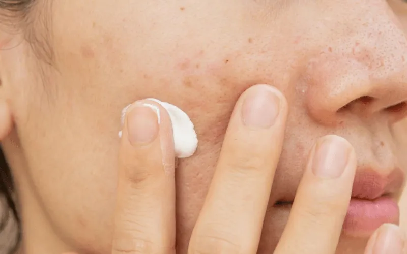 Tips to care for acne-prone skin this summer